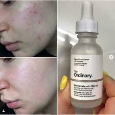 The Ordinary Niacinamide 10% + Zinc 1 % – 30ml